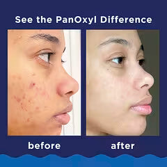 PanOxyl 4%, Nettoyant moussant contre l'acné pour le visage  Efficacité maximale, 85 g